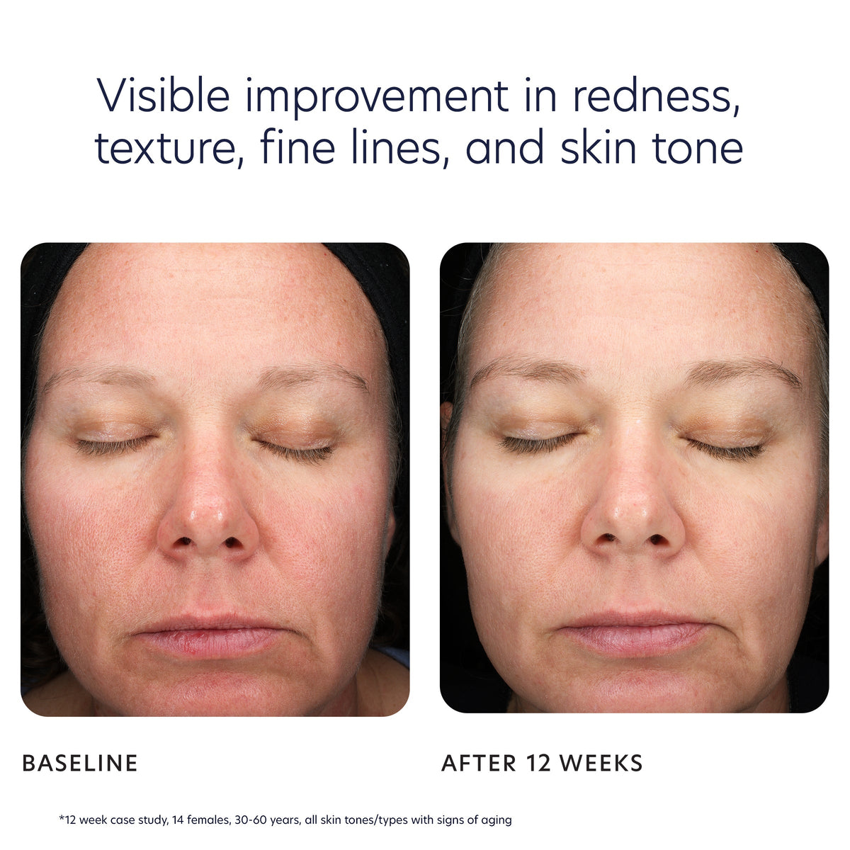 Voor en na 12 weken PCA skin peel pads