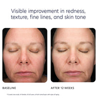 Voor en na 12 weken PCA skin peel pads