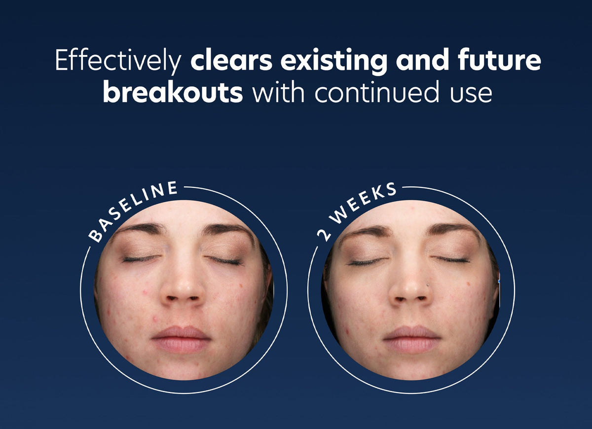 pca skin acne gel before and after