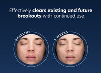 pca skin acne gel before and after