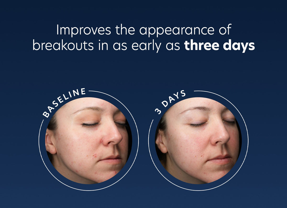 pca skin acne gel voro en na