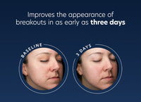 pca skin acne gel voro en na