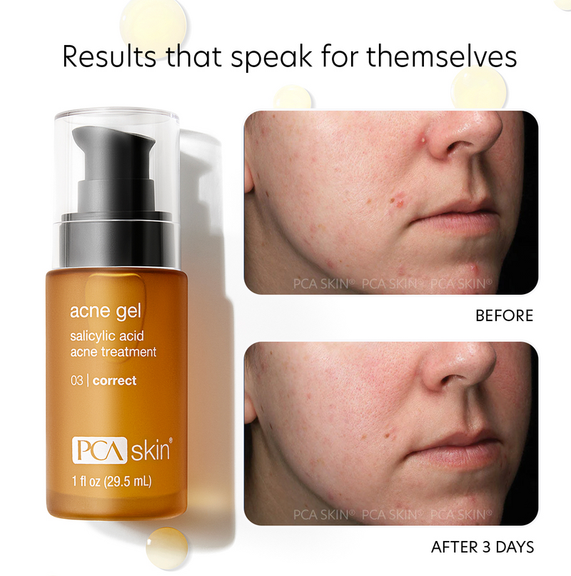 pca skin acne gel voor en na acne behandelen en onzuiverheden