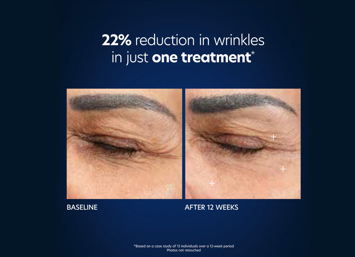 pca skin microneedling hyaluronic acid microneedle eye patches voor en na