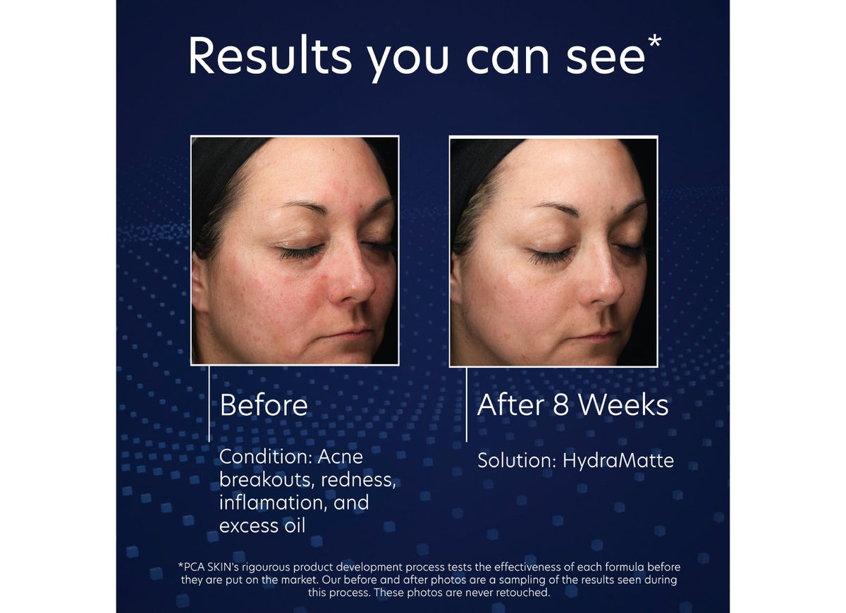pca skin hydra matte oil controlling hydration voor een gemengde huid voor en na before and after