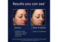 pca skin hydra matte oil controlling hydration voor een gemengde huid voor en na before and after