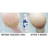 voor en na kloven behandelen kloven met Footlogix cracked heel voetmousse