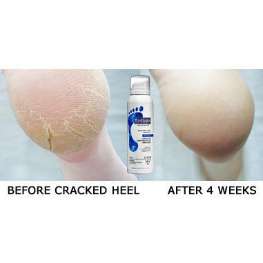 voor en na kloven behandelen kloven met Footlogix cracked heel voetmousse
