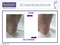 dd cream voetmousse van footlogix voor en na tegen droge voeten
