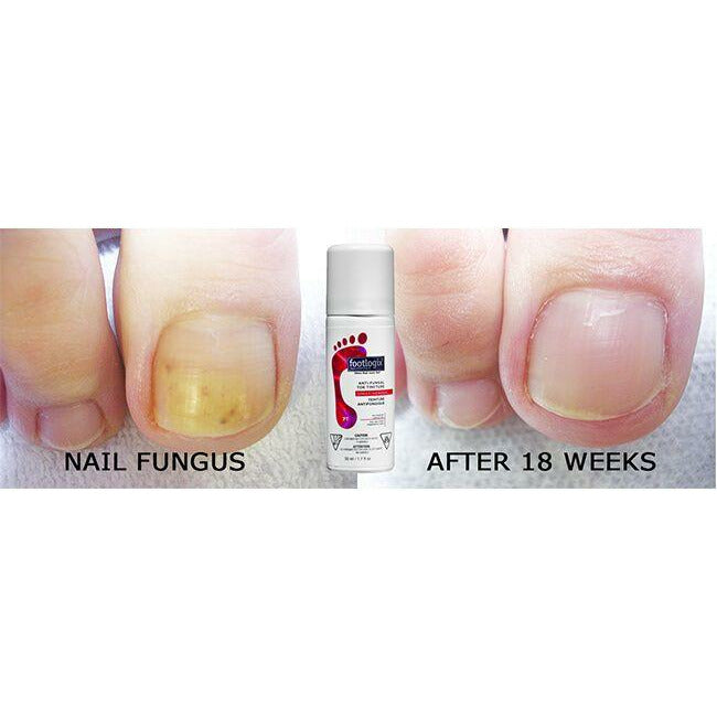 footlogix nail tincture spray voor en na review