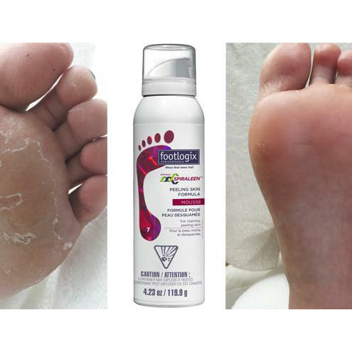 peeling skin voetmousse van footlogix tegen vervellende huid tussen tenen en zwemmerseczeem