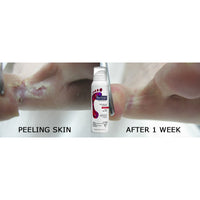 footlogix peeling skin voetmousse voor en na van vervellende huid tussen de tenen