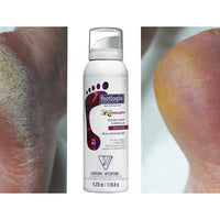 footlogix rough skin voetmousse voor en na review