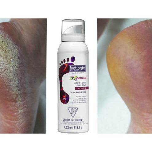 footlogix rough skin voetmousse voor en na review