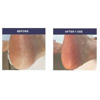 voet eelt verwijderen voor en na review