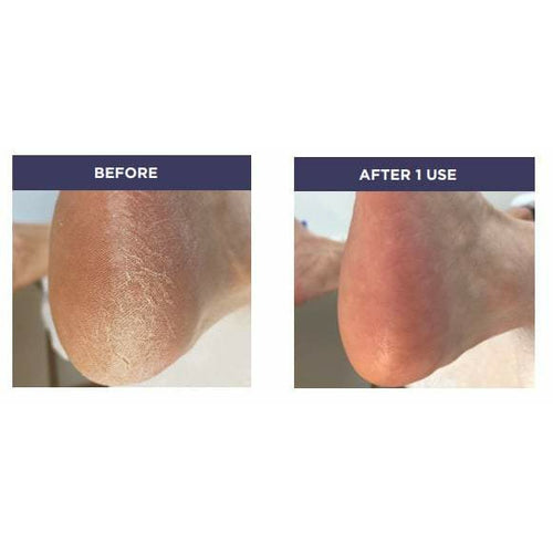 voet eelt verwijderen voor en na review