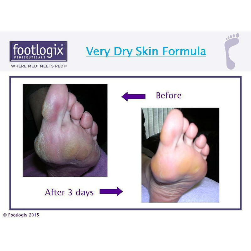 very dry skin voetmousse van Footlogix voor en na review