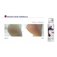 footlogix ruwe voeten voor en na rough skin voetmousse