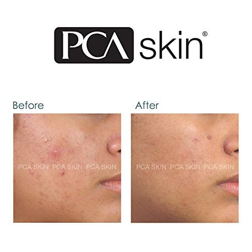 pca skin blemish control bar before and after