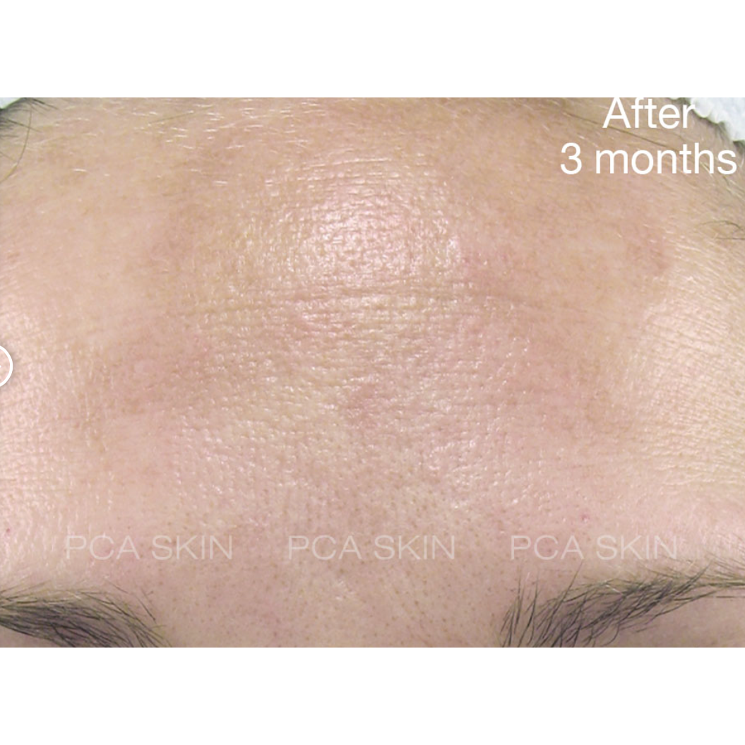 pca skin intensive brightening treatment pure retinol night na