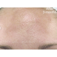 pca skin intensive brightening treatment pure retinol night na