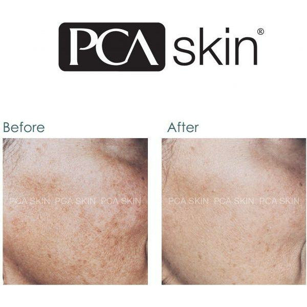 pca skin pigment gel tegen pigmentvlekken gezicht voor en na