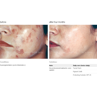 pca skin pigment gel tegen pigmentvlekken gezicht voor en na