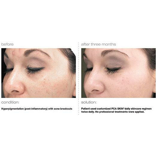 pca skin pigment gel tegen pigmentvlekken gezicht before and after